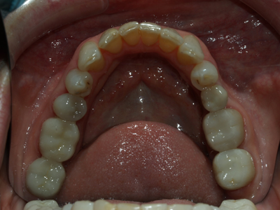 After silver filling replacement with safe composite fillings.