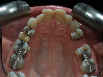 before removal of silver fillings