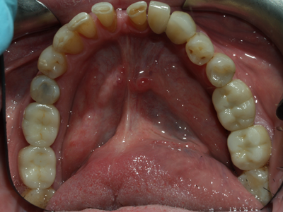 after removing amalgam fillings safely, and replacement with composites.