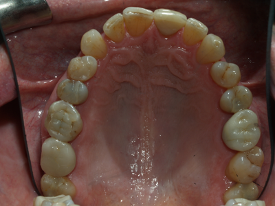 after amalgam fillings removed, dentist replaced with safe composites